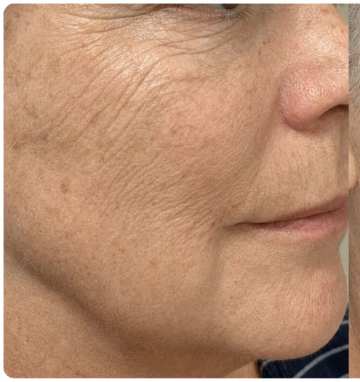 Skin before the Glow Rescue treatment