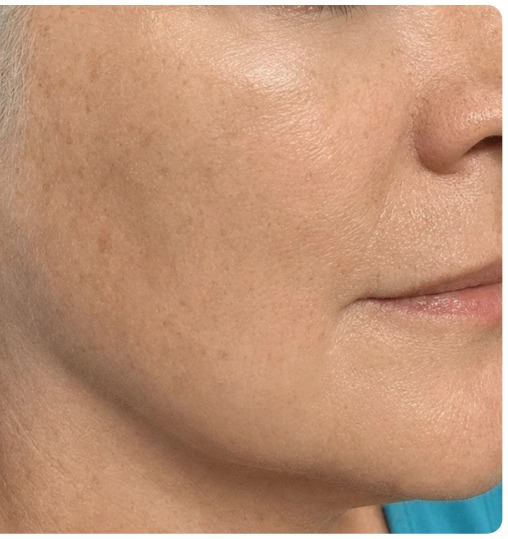 Skin after the Glow Rescue treatment